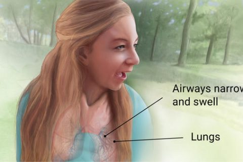 bronchial asthma