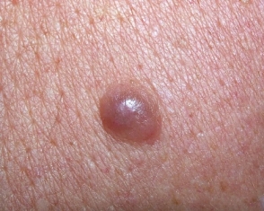 Melanoma Symptoms, Causes, Stages and Treatments Available