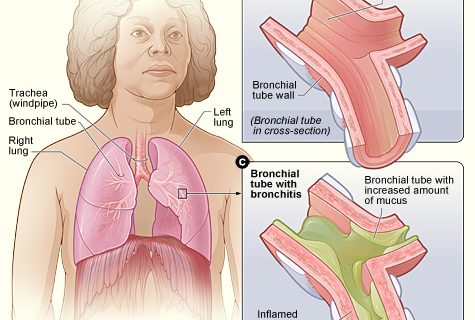 Bronchitis Symptoms, Causes and Home Remedies for Bronchitis