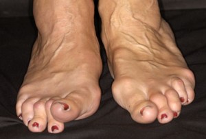 Feet arthritis