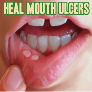 How to Heal Mouth Ulcers