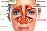 Sinusitis