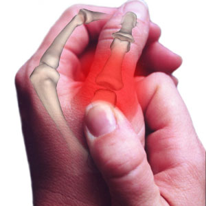 Arthritis; Its Causes, Symptoms and Treatments Available