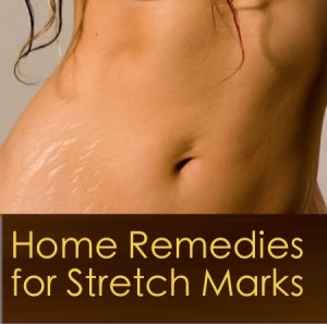 Home Remedies to Get Rid of Stretch Marks