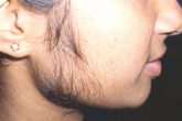 Steroid Side Effects Women - Facial Hair Growth