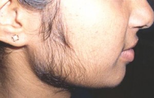 Steroid Side Effects Women - Facial Hair Growth