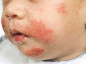 Eczema Symptoms, Causes and Home Remedies for Eczema Treatments