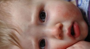 eczema - on a baby