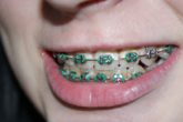 How To Whiten Teeth With Braces?