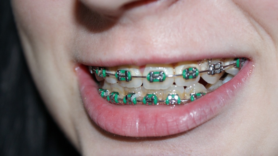 How to Alleviate Braces Pain? – How To Whiten Teeth With Braces?