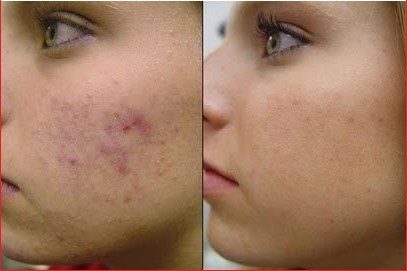 How To Get Rid Of Acne Scars Naturally