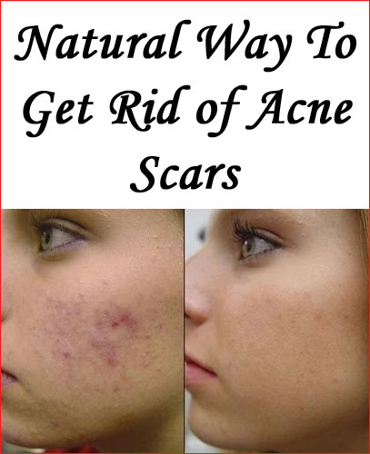 How To Get Rid Of Acne Scars Naturally 7077