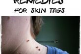Natural Remedies For Skin Tag Removal