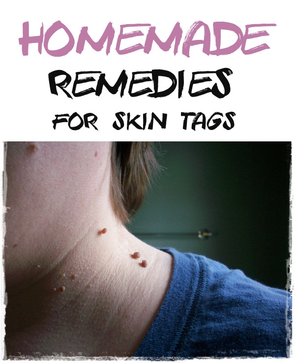 Natural Remedies For Skin Tag Removal