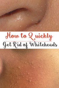 Home Remedies To Get Rid Of Whiteheads