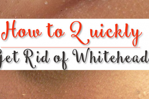 How To Get Rid Of Whiteheads?