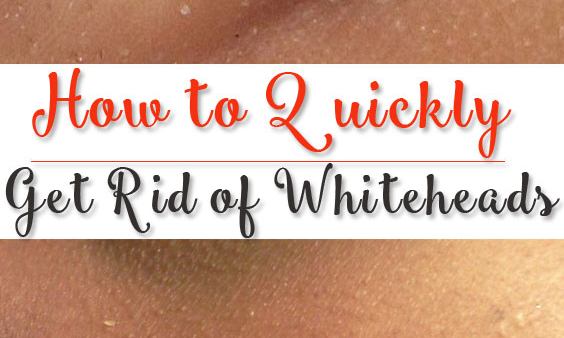 12 Home Remedies To Get Rid Of Whiteheads | Natural Remedies to Remove Whiteheads