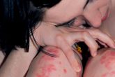 Natural Home Remedies For Psoriasis