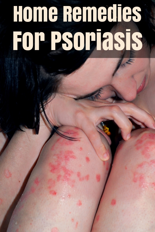 9 Home Remedies For Psoriasis – Natural Remedies For Psoriasis