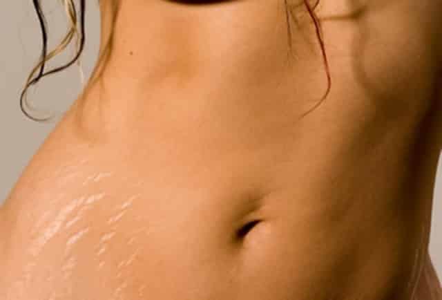How To Get Rid Of Stretch Marks?; Natural Home Remedies