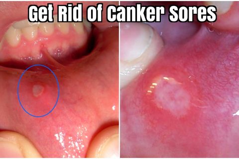 canker sores remedies abscess abscessed