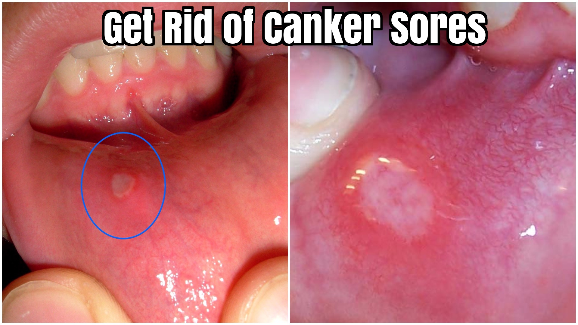 How to Get Rid of Canker Sores Fast? Home Remedies to Get Rid of Canker Sores