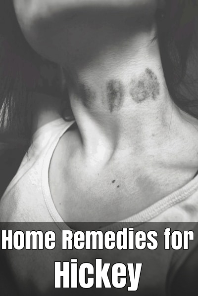 How To Get Rid Of A Hickey Fast 11 Home Remedies For Hickey