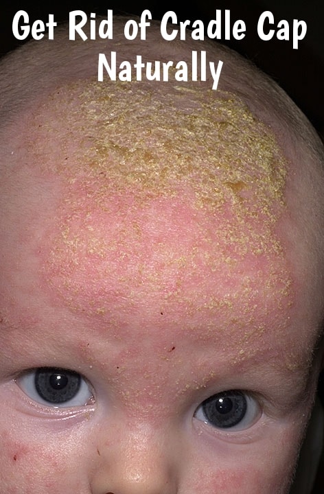 How To Get Rid of Cradle Cap? – Top 10 Home Remedies for Cradle Cap Treatment