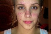 How To Get Rid of Cystic Acne?
