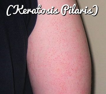 How to Get Rid of Keratosis Pilaris / Chicken Skin