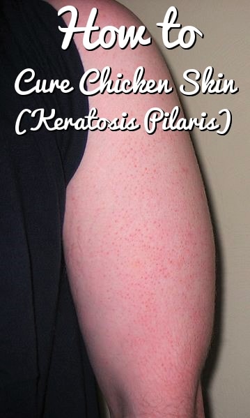 How to Get Rid of Keratosis Pilaris? – Home Remedies for Chicken Skin