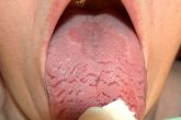 Geographic Tongue Treatment