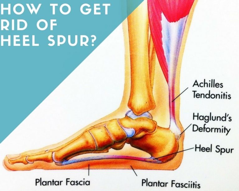 How To Get Rid Of Heel Spur? Home Remedies For Treatment Of Heel Spur