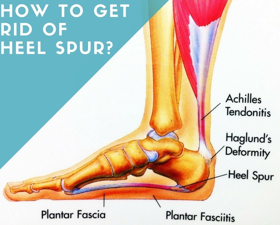 How to Get Rid of Heel Spur? Home Remedies for Treatment of Heel Spur Pain
