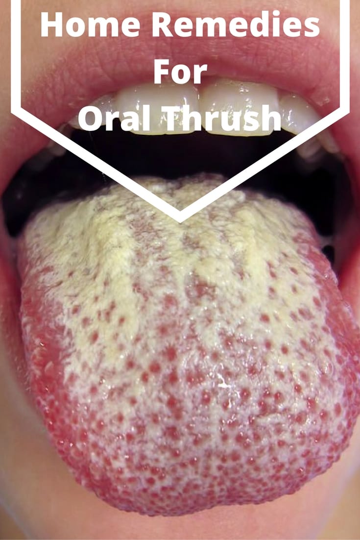 Home Remedies for Oral Thrush Treatment
