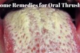How to Get Rid of Oral Thrush?