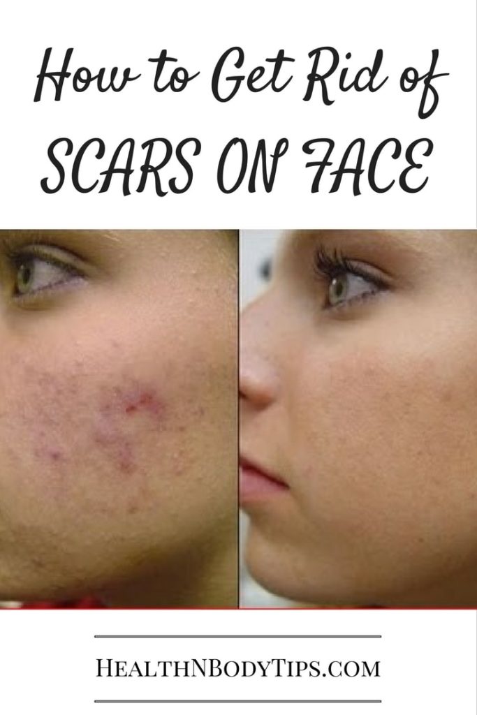 How To Heal Spot Scars On Face