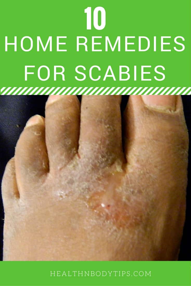 How to Get Rid of Scabies with Natural Home Remedies?