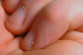 Remedies to Get Rid of Hangnails