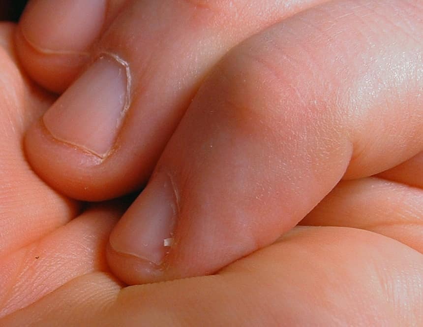 Remedies to Get Rid of Hangnails