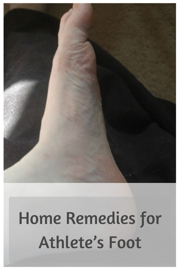 Home Remedies for Athlete's Foot