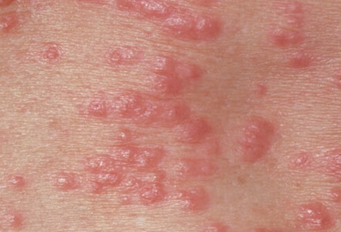 How to Get Rid of Scabies? Top 10 Home Remedies for Scabies