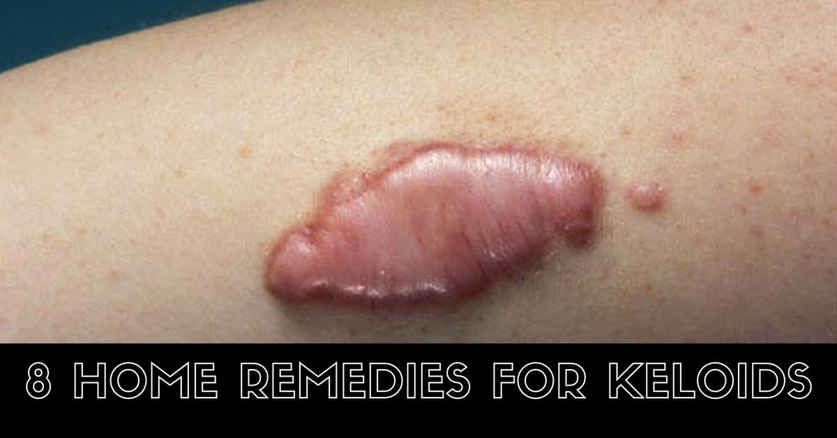 home remedies for Keloids