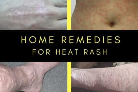 Home Remedies for Heat Rash