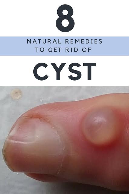 How To Get Rid Of A Cyst?