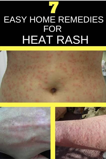 How To Get Rid Of Heat Rash Home Remedies For Prickly Heat 