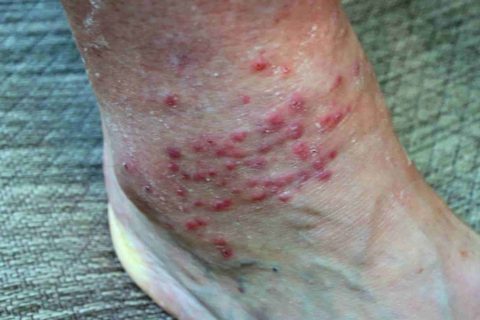 How to Get Rid of Chiggers Bites