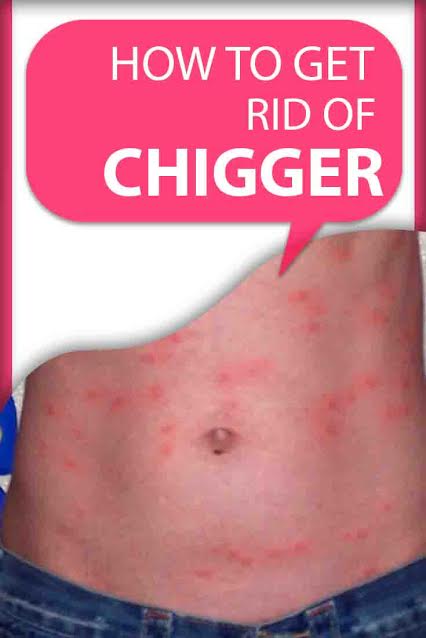 How to Get Rid of Chiggers?