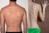 Home remedies to get rid of back acne
