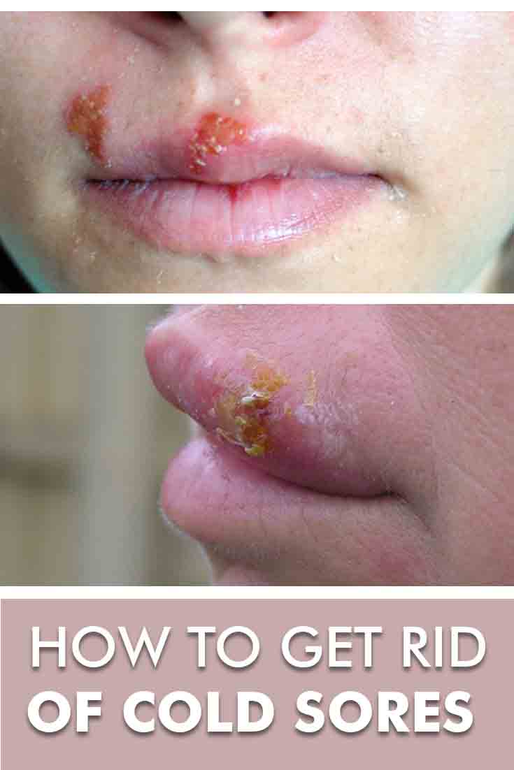 causes-of-cold-sore-on-the-nose-its-treatment-home-remedies